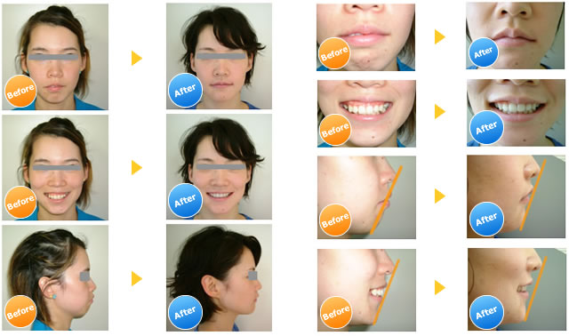 ガミースマイルの症例写真(2)